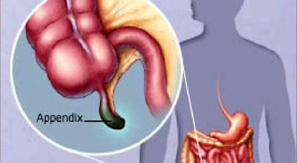 تعبیر خواب آپاندیس و ترکیدن آپاندیس و عمل جراحی آپاندیس در خواب